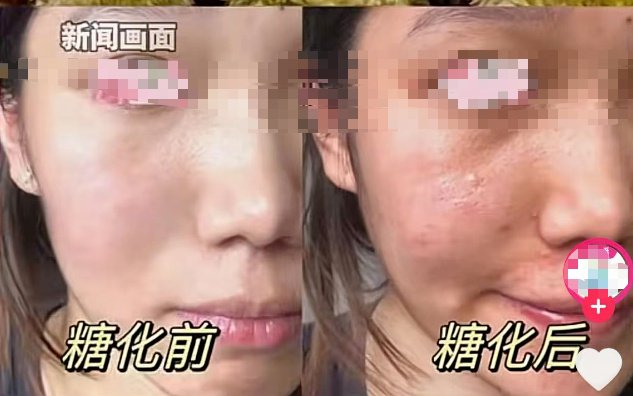▲糖化脸前后对比。来源：新闻报道画面
