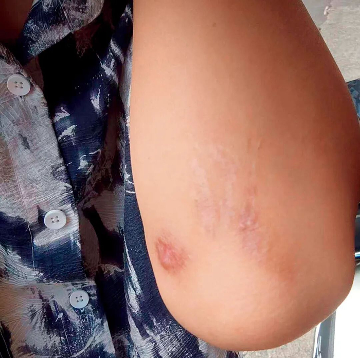 徐小西手臂上被教官抽打的伤痕 图/受访者提供