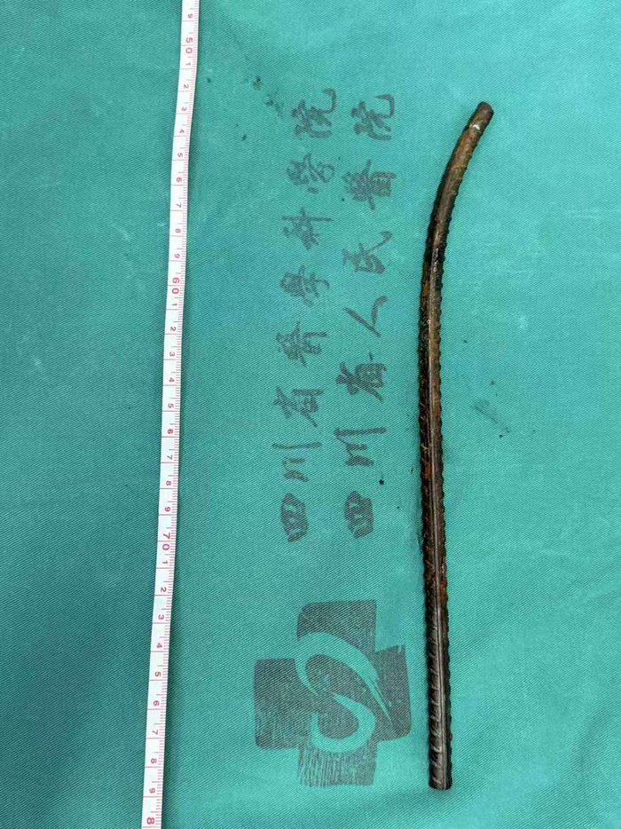 ▲插进体内的钢筋长约30厘米