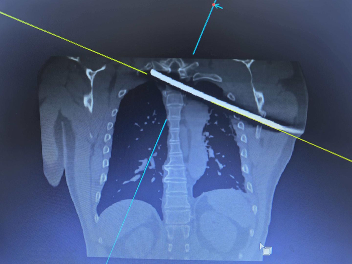 ▲斜插进体内的钢筋