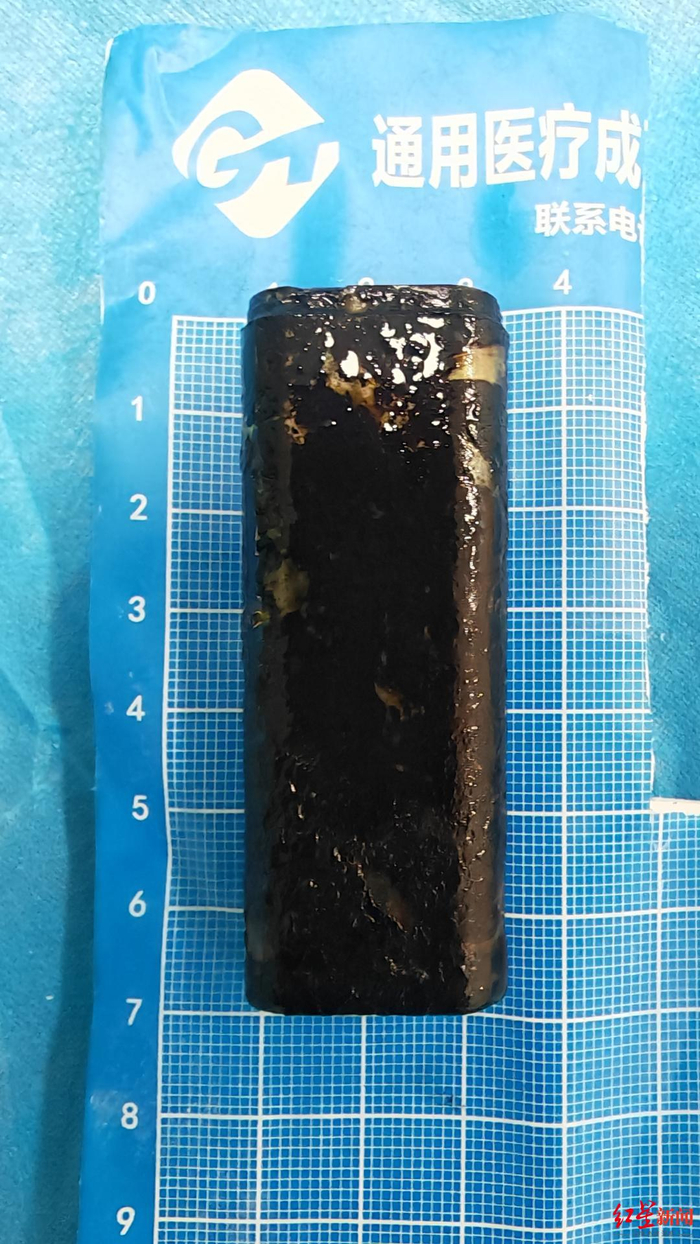 ▲在胃中泡了三十多年的打火机被取出