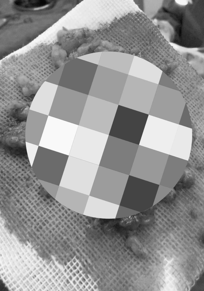 今年10月25日，李梦通过手术取出面部因表皮生长因子注射产生的异物。受访者供图