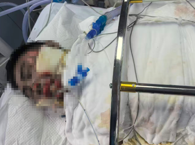 孙师傅伤势危急。图源：贵州广播电视台《百姓关注》栏目 