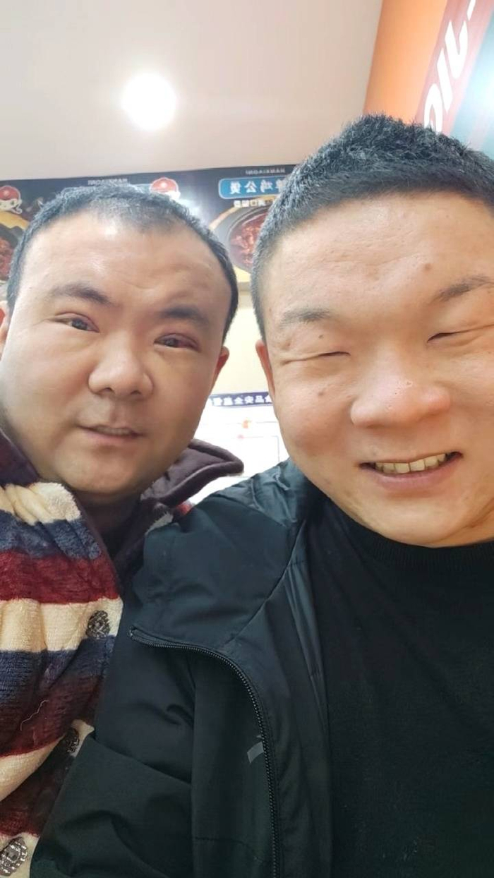 　割完双眼皮的崔磊（左）和弟弟。