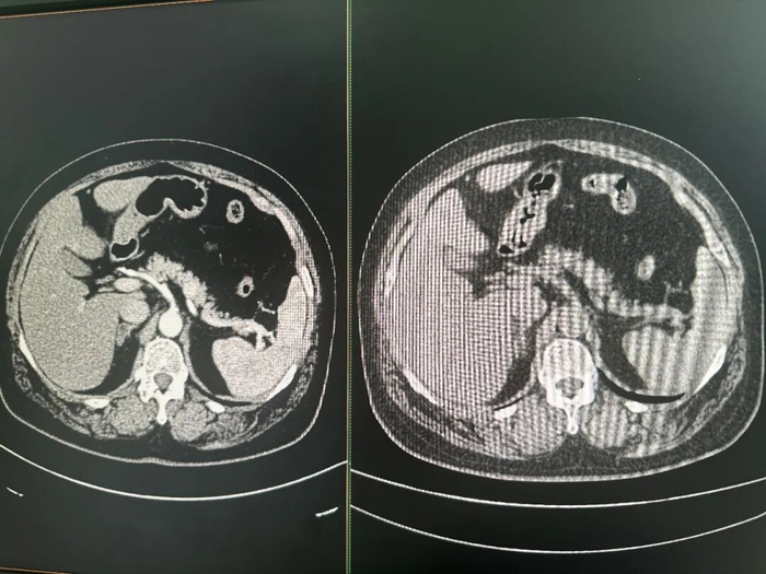 增强CT（左）和平扫CT（右）对比图 图片来源：每经记者 郑雨航 摄