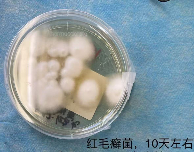 红毛癣菌。受访者供图