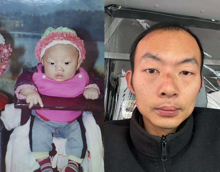 幼时患有唇裂的刘峰与长大后的刘峰/受访者供图