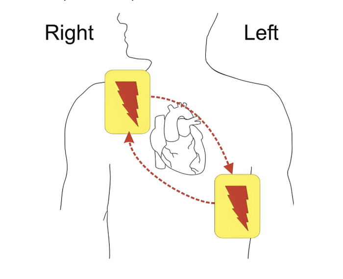 电极片贴片位置。 图/上海市退役军人事务局官微