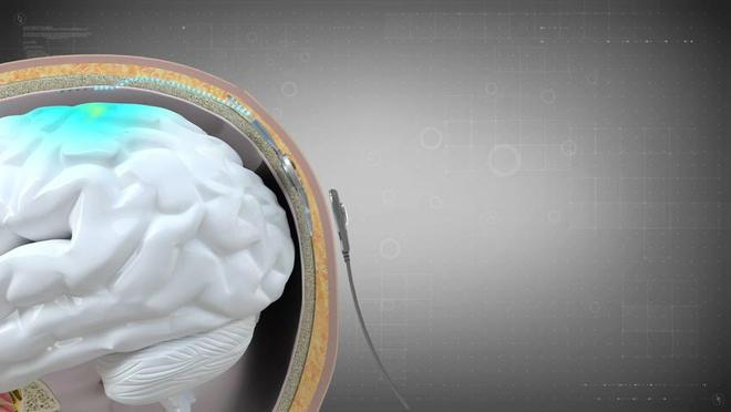 博睿康走独立技术路线，开创了脑机接口在硬脑膜外植入的方案。（受访者供图）