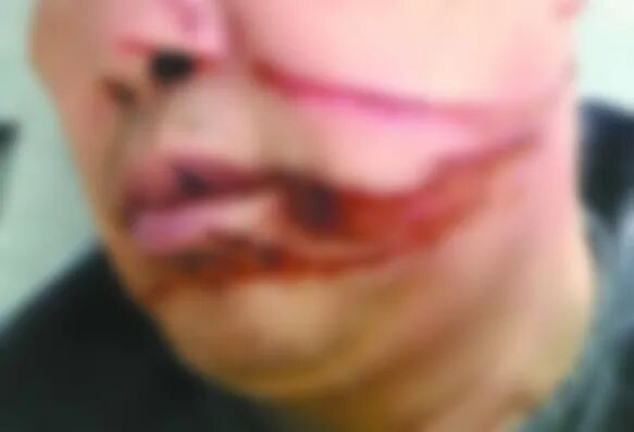 盘先生脸部被风筝线划伤。图源：南充市应急管理局