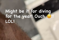 詹姆斯自拍展示右腿上的伤口：可能是年度最佳扑球造成的！好痛！