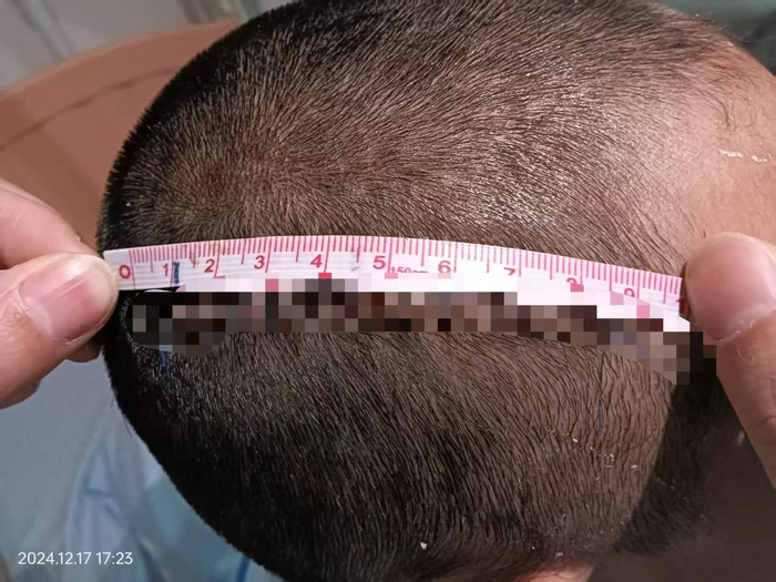 ▲项某某头部被砍击 受访者供图