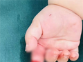 妈妈抱娃拆快递：不慎剪断7岁女儿食指 手术3小时成功接上