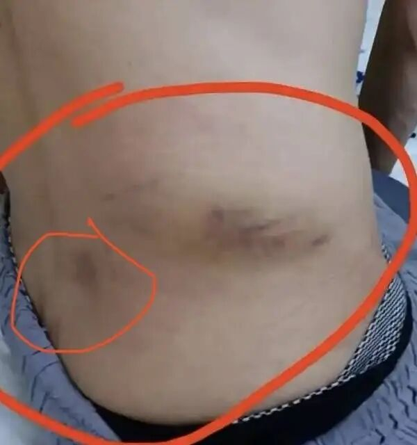 王先生腰部受伤