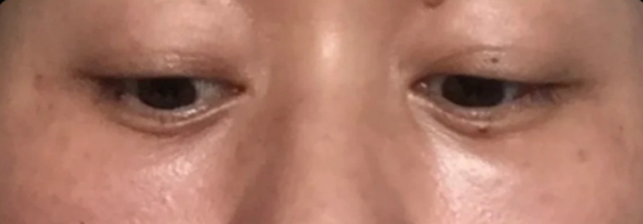 二胎怀双胞胎的代价