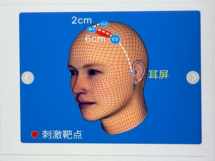 此次研究中选取的是左侧初级运动皮层（M1）作为新的靶点。
