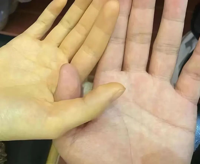 蚕豆病患者与正常人的肤色对比