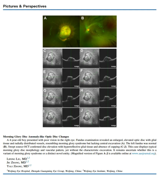 Morning Glory Disc Anomaly-like Optic Disc Changes文献截图
