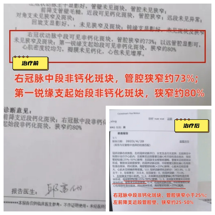 图：冠脉堵塞患者检查报告前后对比