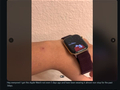 苹果Apple Watch S12被曝引发皮肤不适！有用户佩戴后手腕发红、出现灼烧感
