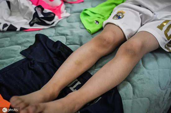 祖力凯迪腿上的伤疤