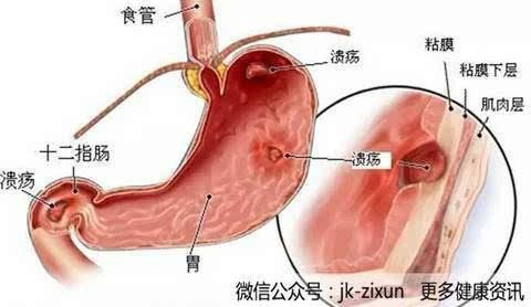 5、胃溃疡、慢性阑尾炎、胆囊炎