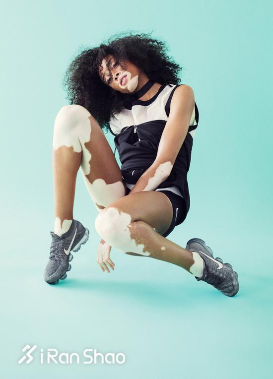 世界上唯一一位身患白癜风却成为顶级超模的女生Winnie Harlow