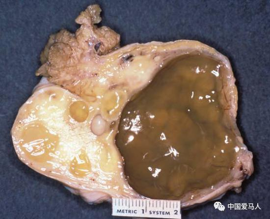  ▲ 卵巢纵切（大卵泡）