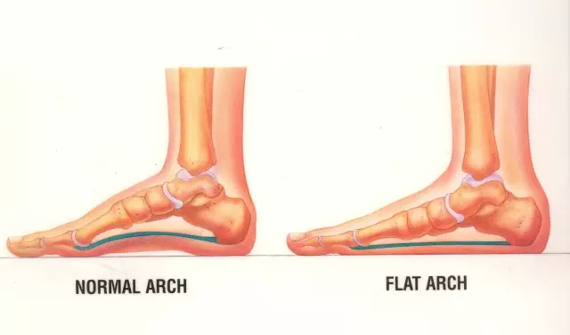 　　▲ 左图是正常足弓，右图是扁平足足弓（足弓塌陷）