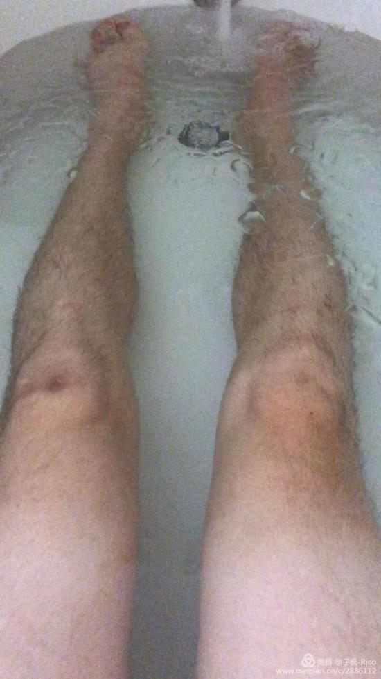 泡个冰水浴停止伤痛 促进恢复