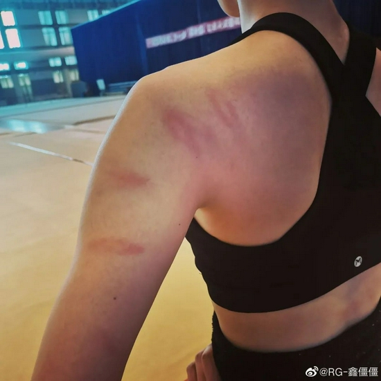 刘鑫训练后身上的伤痕