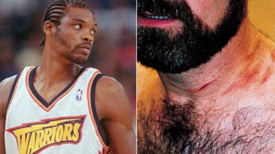 卡莱西莫脖颈处伤痕清晰可见