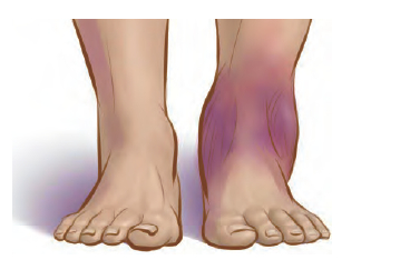 2。 想办法冷敷处理