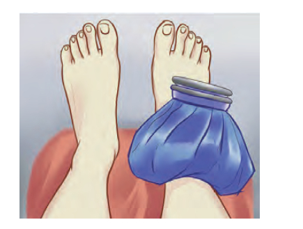 3。 冷敷后加压包扎