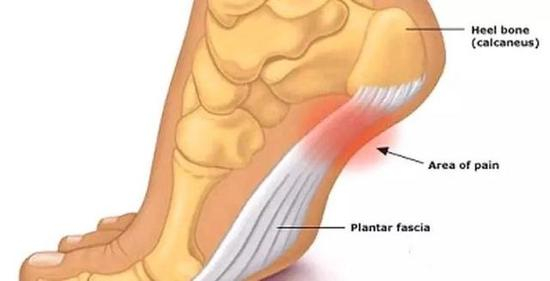 足底筋摸炎位置