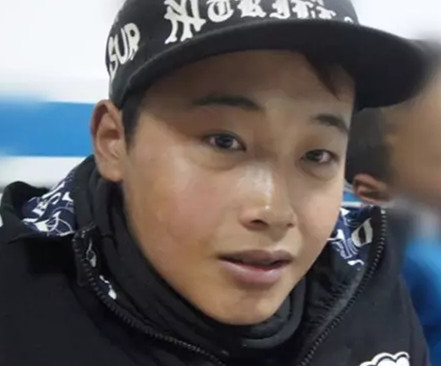 脊柱畸形患儿尕松小朋友