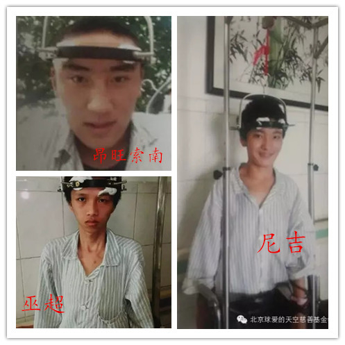 脊柱畸形患儿昂旺索南，尼吉，巫超三位小朋友