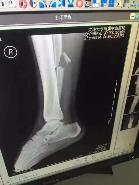哈萨克媒体曝光的X光片