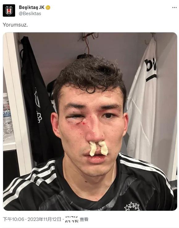 土超联赛一球员比赛中被揍的鼻青脸肿