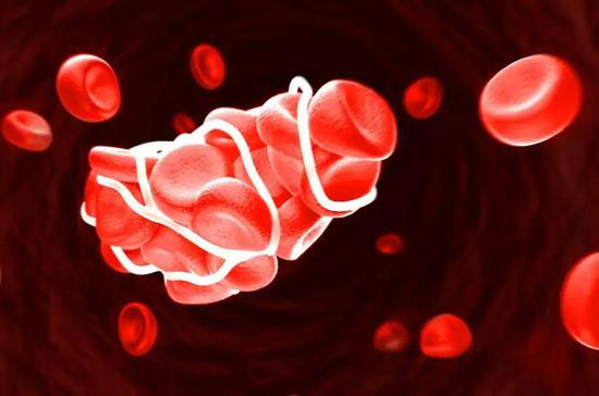  凝血因子参与形成血栓（图片来源：作者提供）