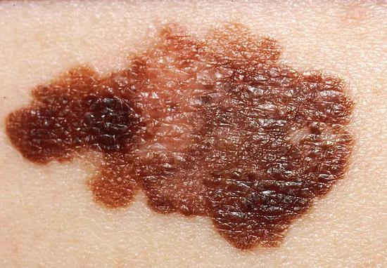 黑色素瘤（Melanoma）是20-30岁人群中最常见的癌症之一&nbsp;