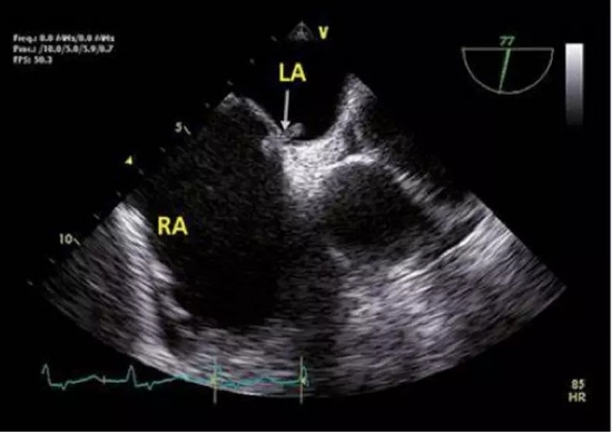 卵圆孔处的骑跨血栓