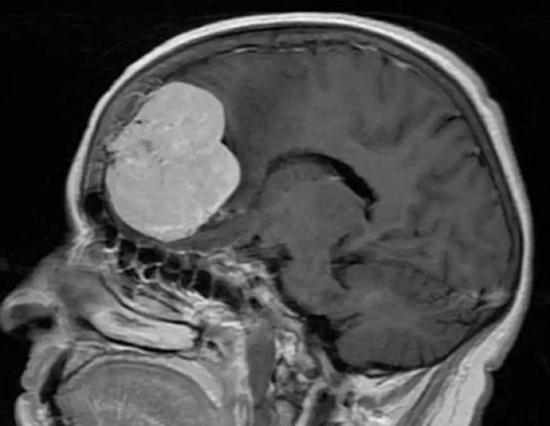 　脑膜瘤