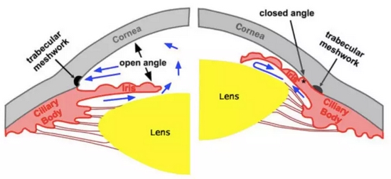 开角及闭角型青光眼