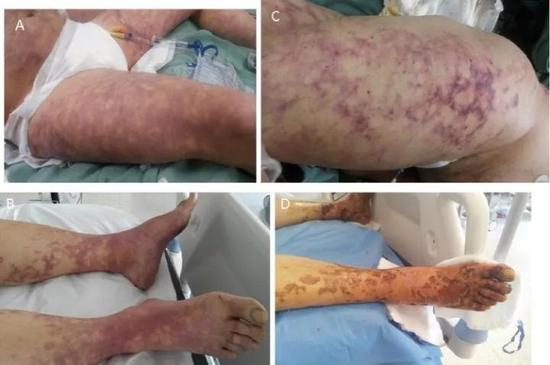 感染犬咬二氧化碳嗜纤维菌后，患者体表明显出现的青紫斑迹。图源：ScienceDirect