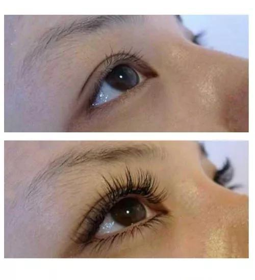 &nbsp;比马前列腺素（bimatoprost）：曾在2008年经FDA批准用于治疗青光眼，该药也有促进睫毛生长的作用。图源：OKDERMO