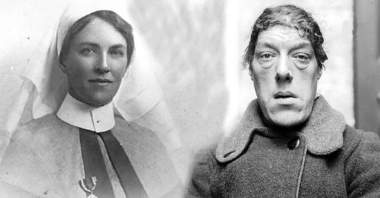 Mary Ann Bevan 生病前后容貌的变化。图片来源：wikimedia