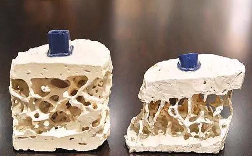 图2 正常人骨骼（左）和骨质疏松患者骨骼（右）对照（图片来源自网络）