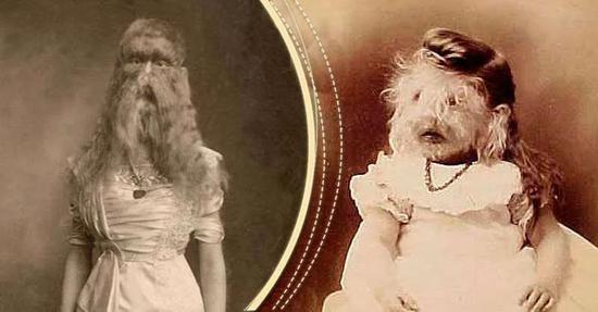 　Dreamland 马戏团的另一位罕见病演员：患有胎毛增多症的Blue-eyed Doherty。图片来源：wikimedia