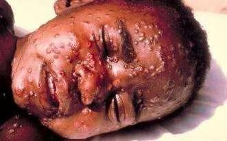 天花症状（图片来源：百度图库）